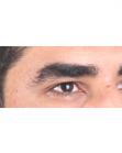 Before Hair Transplant&nbsp;Eyebrows